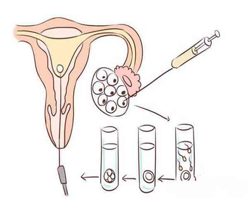 供精助孕是否必须手术？专业解答与选择